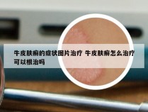 牛皮肤癣的症状图片治疗 牛皮肤癣怎么治疗可以根治吗