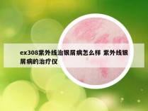 ex308紫外线治银屑病怎么样 紫外线银屑病的治疗仪