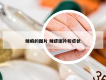 糠癣的图片 糠疹图片和症状