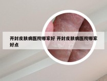 开封皮肤病医院哪家好 开封皮肤病医院哪家好点