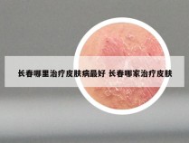 长春哪里治疗皮肤病最好 长春哪家治疗皮肤