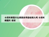 小孩长癣是什么原因会传染给别人吗 小孩长癣图片 症状