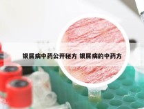 银屑病中药公开秘方 银屑病的中药方