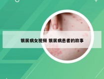 银屑病女视频 银屑病患者的故事