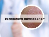 掌趾脓疱最终会怎样 掌趾脓疱用什么药治疗