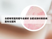 合肥哪家医院看牛皮癣好 合肥皮肤科银屑病最有名医院