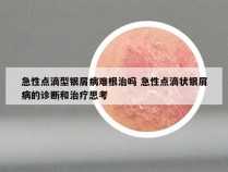 急性点滴型银屑病难根治吗 急性点滴状银屑病的诊断和治疗思考