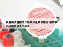 银屑病消退期又长出来红色疹子原因 银屑病已经消退又长小红点