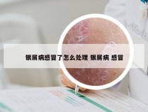 银屑病感冒了怎么处理 银屑病 感冒