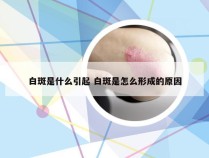 白斑是什么引起 白斑是怎么形成的原因