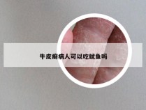 牛皮癣病人可以吃鱿鱼吗