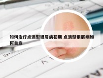 如何治疗点滴型银屑病初期 点滴型银屑病如何自愈