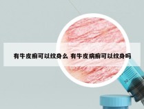 有牛皮癣可以纹身么 有牛皮病癣可以纹身吗