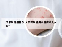 父亲银屑病怀孕 父亲有银屑病会遗传绘儿女吗?