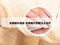 皮癣图片腿部 皮癣图片初期怎么治疗