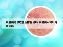 银屑病可以吃墨鱼排骨汤吗 银屑病人可以吃黑鱼吗