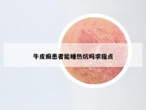 牛皮癣患者能睡热炕吗求指点