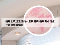 指甲上坑坑洼洼的小点银屑病 指甲有小凹点一定是银屑病吗