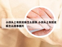 小孩头上有脱皮癣怎么回事 小孩头上有脱皮癣怎么回事图片