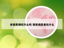 有银屑病吃什么吗 银屑病患者吃什么