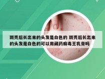 斑秃后长出来的头发是白色的 斑秃后长出来的头发是白色的可以用藏药癣毒王乳膏吗