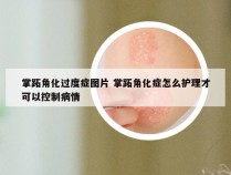 掌跖角化过度症图片 掌跖角化症怎么护理才可以控制病情