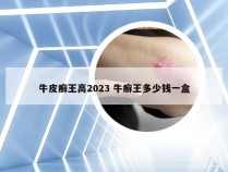 牛皮癣王高2023 牛癣王多少钱一盒