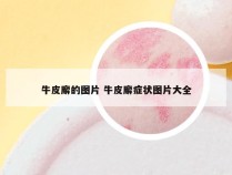 牛皮廨的图片 牛皮廨症状图片大全