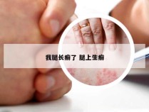 我腿长癣了 腿上生癣