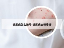 银屑病怎么挂号 银屑病去哪看好