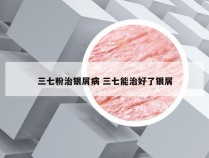 三七粉治银屑病 三七能治好了银屑