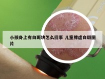 小孩身上有白斑块怎么回事 儿童脾虚白斑图片