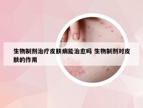 生物制剂治疗皮肤病能治愈吗 生物制剂对皮肤的作用