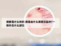 癣都是什么样的 癣是由什么原因引起的?一般长在什么部位