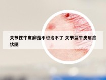 关节性牛皮癣是不也治不了 关节型牛皮屑症状图