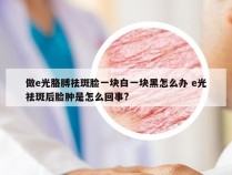 做e光胳膊祛斑脸一块白一块黑怎么办 e光祛斑后脸肿是怎么回事?