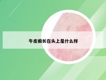 牛皮癣长在头上是什么样