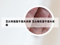 怎么知道是不是头皮癣 怎么确定是不是头皮癣