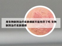 用生物制剂治疗皮肤病就不能停药了吗 生物制剂治疗皮肤瘙痒