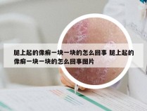 腿上起的像癣一块一块的怎么回事 腿上起的像癣一块一块的怎么回事图片