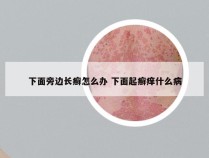 下面旁边长癣怎么办 下面起癣痒什么病