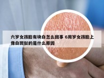 六岁女孩脸有块白怎么回事 6周岁女孩脸上像白斑似的是什么原因