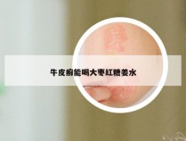 牛皮癣能喝大枣红糖姜水