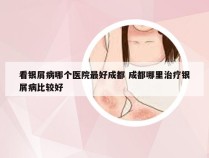 看银屑病哪个医院最好成都 成都哪里治疗银屑病比较好