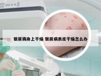 银屑病身上干燥 银屑病表皮干燥怎么办