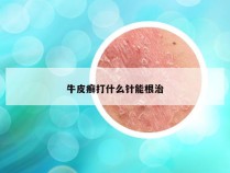 牛皮癣打什么针能根治