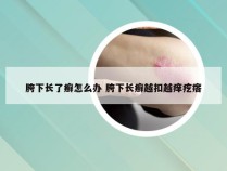 胯下长了癣怎么办 胯下长癣越扣越痒疙瘩