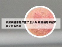 银屑病越来越严重了怎么办 银屑病越来越严重了怎么办呢