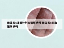 维生素c注射针剂治银屑病吗 维生素c能治银屑病吗