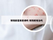 铜钱藓是银屑病吗 铜钱癣难治吗